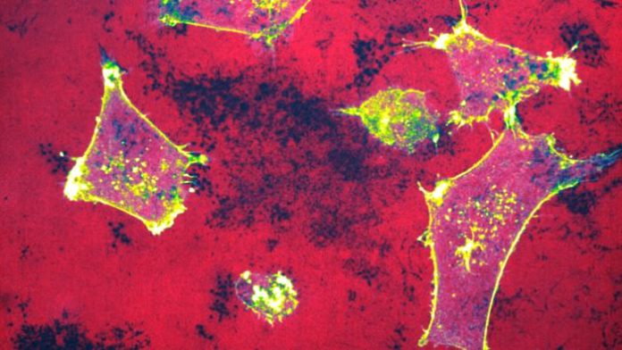 Low-Res_photo-Ivaska-et-al Microscopy image of invasive breast cancer cells (labelled in yellow) degrading their underlying extracellular matrix (labelled gelatin in red, degraded areas appear as black holes). Scale bar, 20µm. Credit Omkar Joshi / Turku Bioscience Centre, University of Turku
