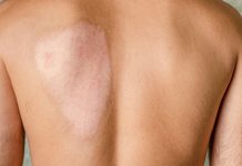 Healed scar after second degree skin burn