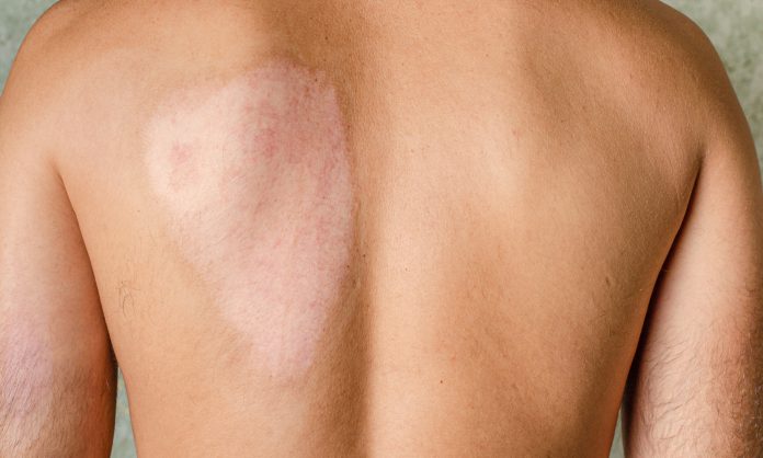 Healed scar after second degree skin burn