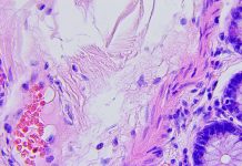 Colon cancer microscopic photograph