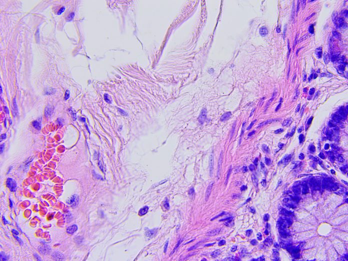 Colon cancer microscopic photograph
