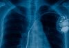 pacemaker cell x-ray image