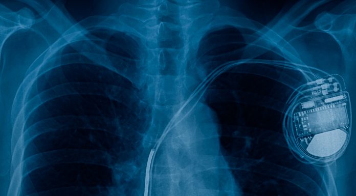 pacemaker cell x-ray image