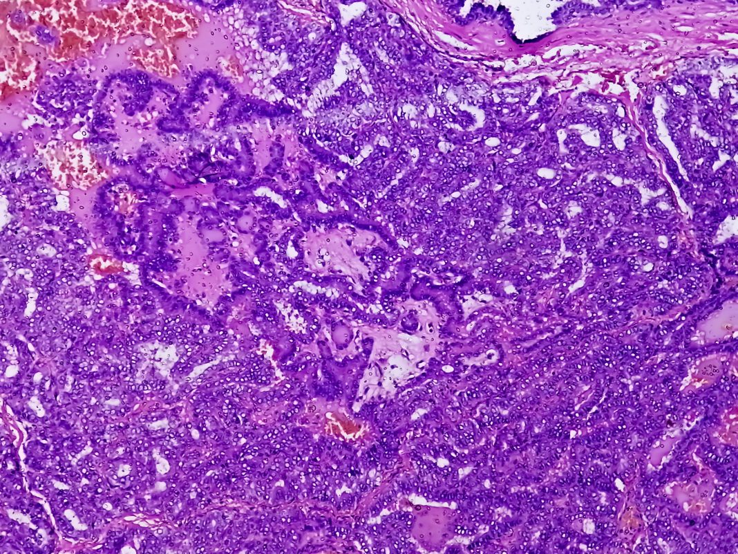 Metastatic papillary thyroid carcinoma (cancer), central lymph node.