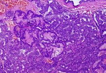 Metastatic papillary thyroid carcinoma (cancer), central lymph node.