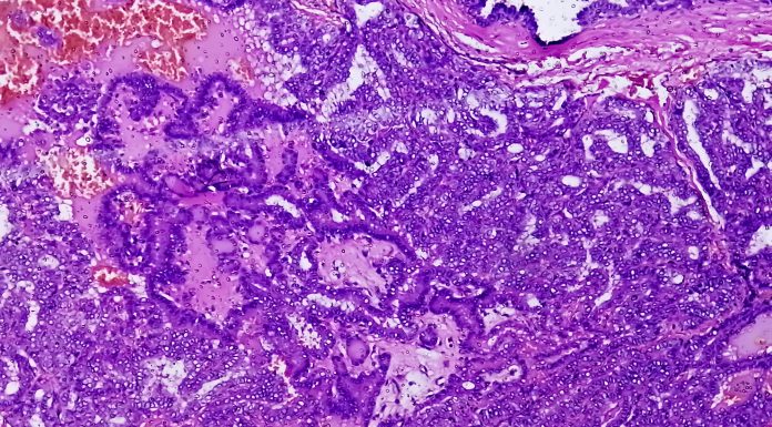 Metastatic papillary thyroid carcinoma (cancer), central lymph node.