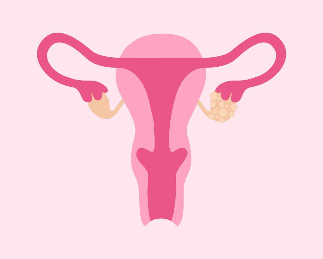 Polycystic Ovary Syndrome. Female Reproductive System With Ovarian Cysts