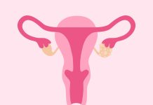 Polycystic Ovary Syndrome. Female Reproductive System With Ovarian Cysts