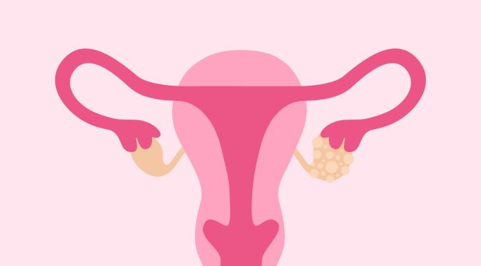 Polycystic Ovary Syndrome. Female Reproductive System With Ovarian Cysts