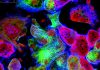 Tumor cells under microscope