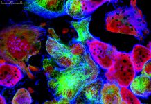 Tumor cells under microscope