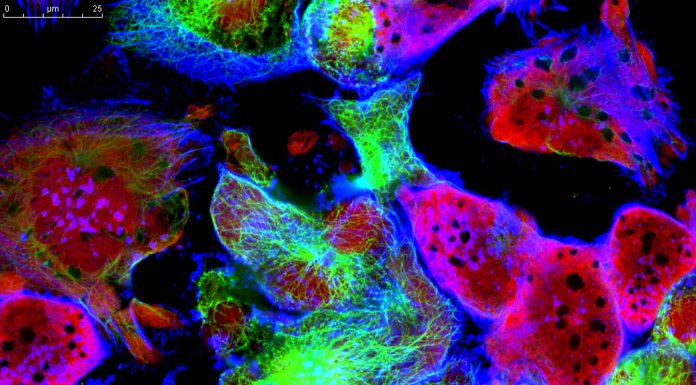 Tumor cells under microscope