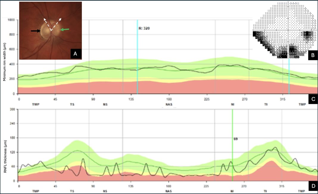 Figure 1. Case referred for normal-tension glaucoma. 1A: Optic nerve head showing slight blurring at the nasal margin (green arrow) and temporal peripapillary atrophy (black arrow). 1B: Corresponding visual field showing an inferior defect. 1C and 1D: Reverse of the glaucomatous sequence of OCT profile curves (in black) showing a minimal rim width (1C) within the normal green band, while the nasal section of the retinal nerve fiber layer (RNFL) is located within the abnormal red band (1D). The RNFL also exhibits a wavy appearance related to its alteration. Radial OCT slices revealed optic nerve drusen buried in the superior and nasal portion of the optic nerve head delineated by the dotted white arrows. Figure 1: Courtesy of Nana Wandji Brenda.