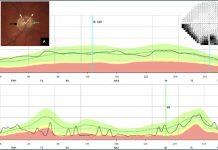 Figure 1. Case referred for normal-tension glaucoma. 1A: Optic nerve head showing slight blurring at the nasal margin (green arrow) and temporal peripapillary atrophy (black arrow). 1B: Corresponding visual field showing an inferior defect. 1C and 1D: Reverse of the glaucomatous sequence of OCT profile curves (in black) showing a minimal rim width (1C) within the normal green band, while the nasal section of the retinal nerve fiber layer (RNFL) is located within the abnormal red band (1D). The RNFL also exhibits a wavy appearance related to its alteration. Radial OCT slices revealed optic nerve drusen buried in the superior and nasal portion of the optic nerve head delineated by the dotted white arrows. Figure 1: Courtesy of Nana Wandji Brenda.