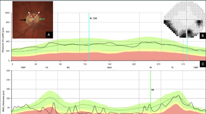 Figure 1. Case referred for normal-tension glaucoma. 1A: Optic nerve head showing slight blurring at the nasal margin (green arrow) and temporal peripapillary atrophy (black arrow). 1B: Corresponding visual field showing an inferior defect. 1C and 1D: Reverse of the glaucomatous sequence of OCT profile curves (in black) showing a minimal rim width (1C) within the normal green band, while the nasal section of the retinal nerve fiber layer (RNFL) is located within the abnormal red band (1D). The RNFL also exhibits a wavy appearance related to its alteration. Radial OCT slices revealed optic nerve drusen buried in the superior and nasal portion of the optic nerve head delineated by the dotted white arrows. Figure 1: Courtesy of Nana Wandji Brenda.