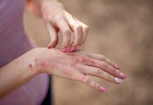 eczema dermatitis on hands and feet. red spots on the skin. dry skinThe concept dermatology, treatment fungal. woman scratching her hand