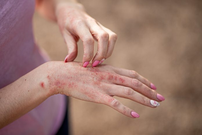 eczema dermatitis on hands and feet. red spots on the skin. dry skinThe concept dermatology, treatment fungal. woman scratching her hand