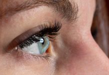 Female eye affected by keratoconus, or conical cornea