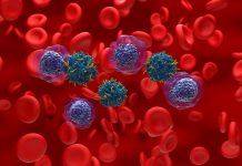 UK’s first MS patient receives CAR T-cell therapy in landmark trial Acute myeloid leukemia AML is a type of blood cancer. It starts in your bone marrow, the soft inner parts of bones. AML usually begins in cells that turn into white blood cells, but it can start in other blood-forming cells, as well.