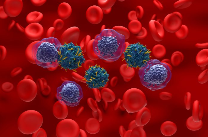 CAR T cell therapy in Acute myeloid leukaemia (AML) - isometric view 3d illustration Acute myeloid leukemia AML is a type of blood cancer. It starts in your bone marrow, the soft inner parts of bones. AML usually begins in cells that turn into white blood cells, but it can start in other blood-forming cells, as well.