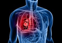 lung cancer