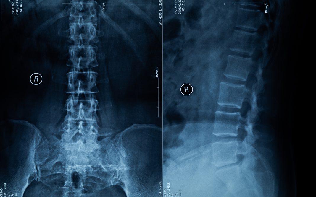 Spine X-ray Film