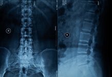 Spine X-ray Film