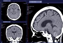 AI brain scan model spots strokes, tumours and aneurysms CT scan of the brain