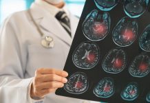 Doctor radiology looking stroke brain x-ray image for diagnose ischemic stroke or cerebrovascular disease at hospital.