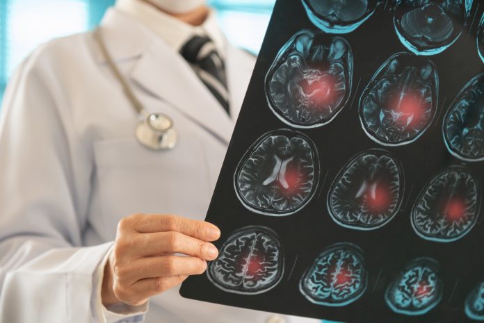 Doctor radiology looking stroke brain x-ray image for diagnose ischemic stroke or cerebrovascular disease at hospital.