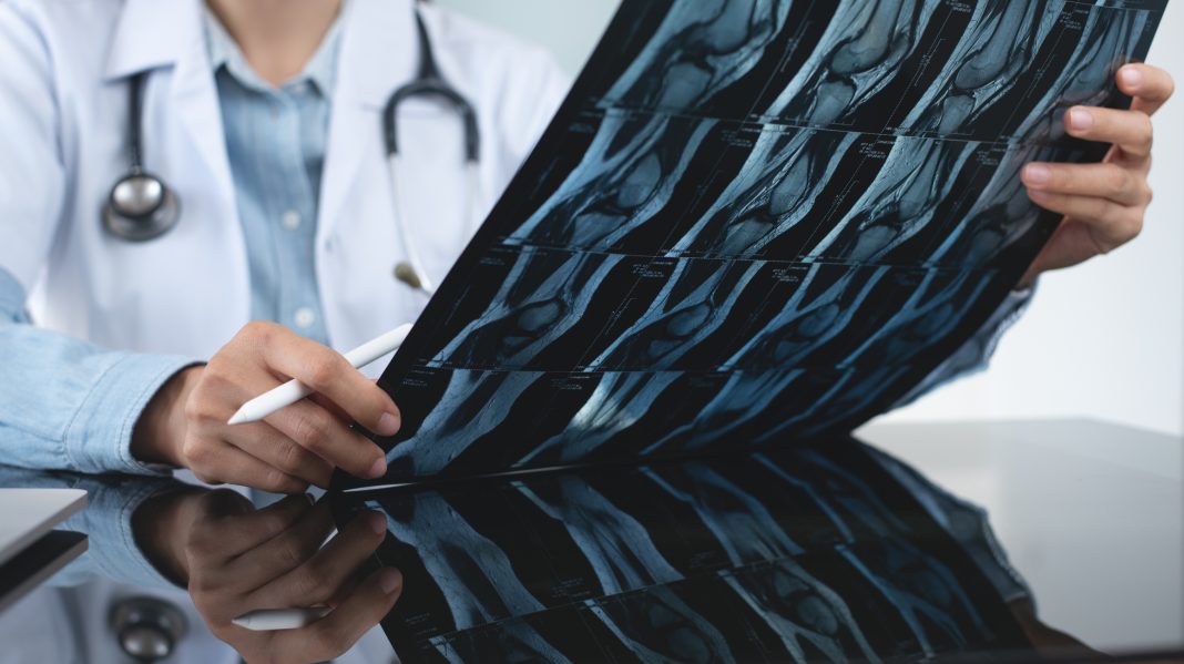 Orthopedics surgeon doctor examining patient's knee joint x-ray films, MRI bone, ct scan in at radiology orthopedic unit in hospital. knee joint film x ray, close up