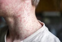 Measles viral disease, human skin covered with measles rash, vaccination concept