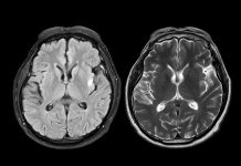 MRI brain scan axial T1W for detect Brain diseases sush as stroke disease, Brain tumors and Infections.
