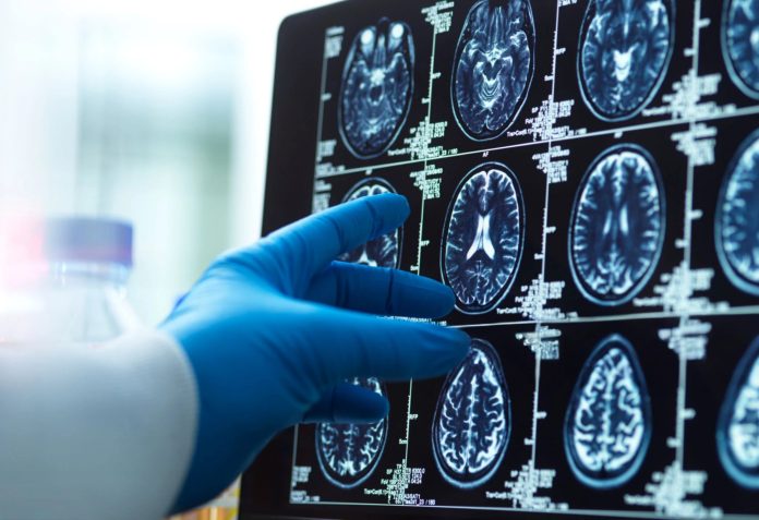 Brain scan image with a doctor's hand, representing medical diagnosis and research.